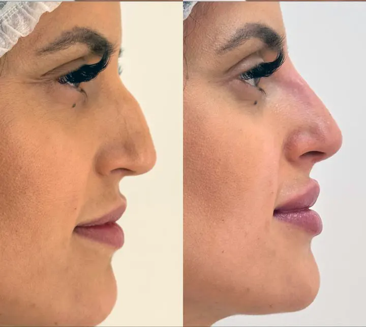 Antes e depois facial