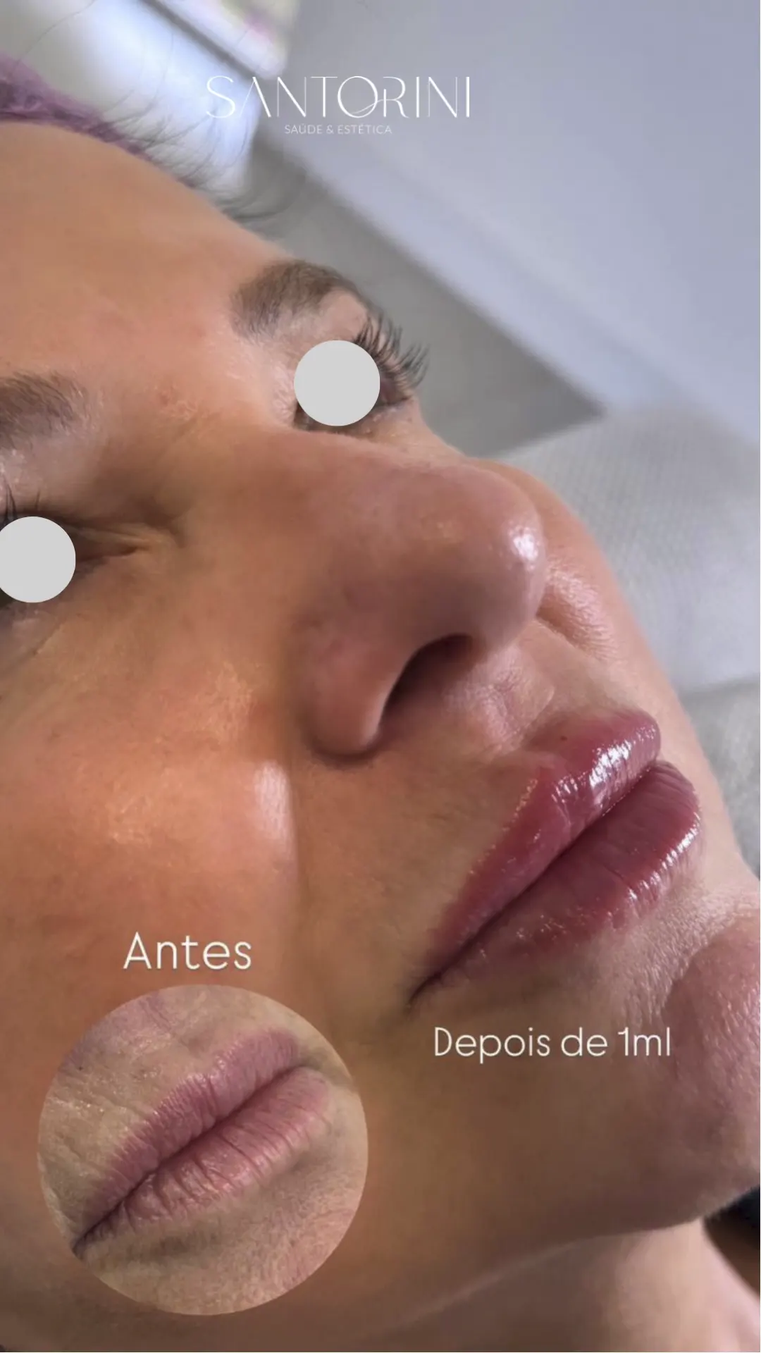 Procedimento de botox com antes e depois 02