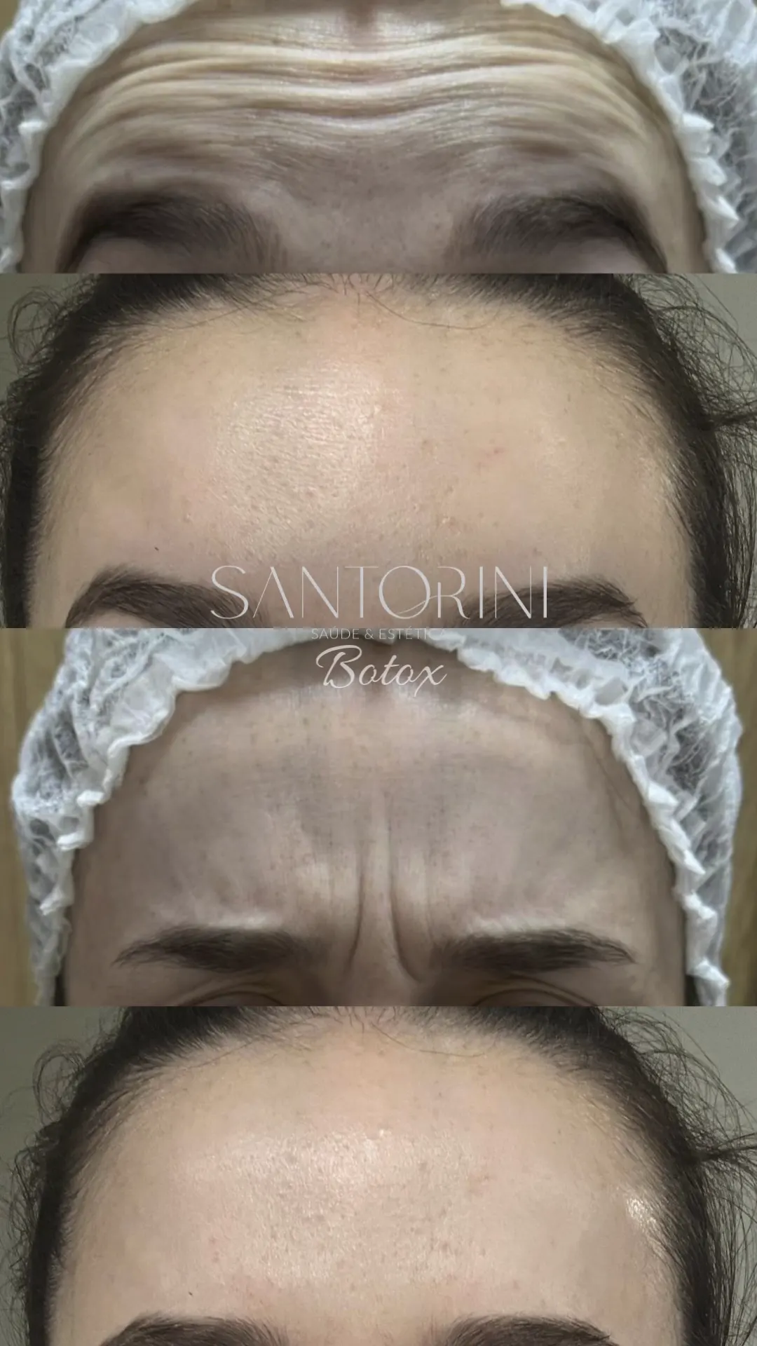 Procedimento de botox com antes e depois 03