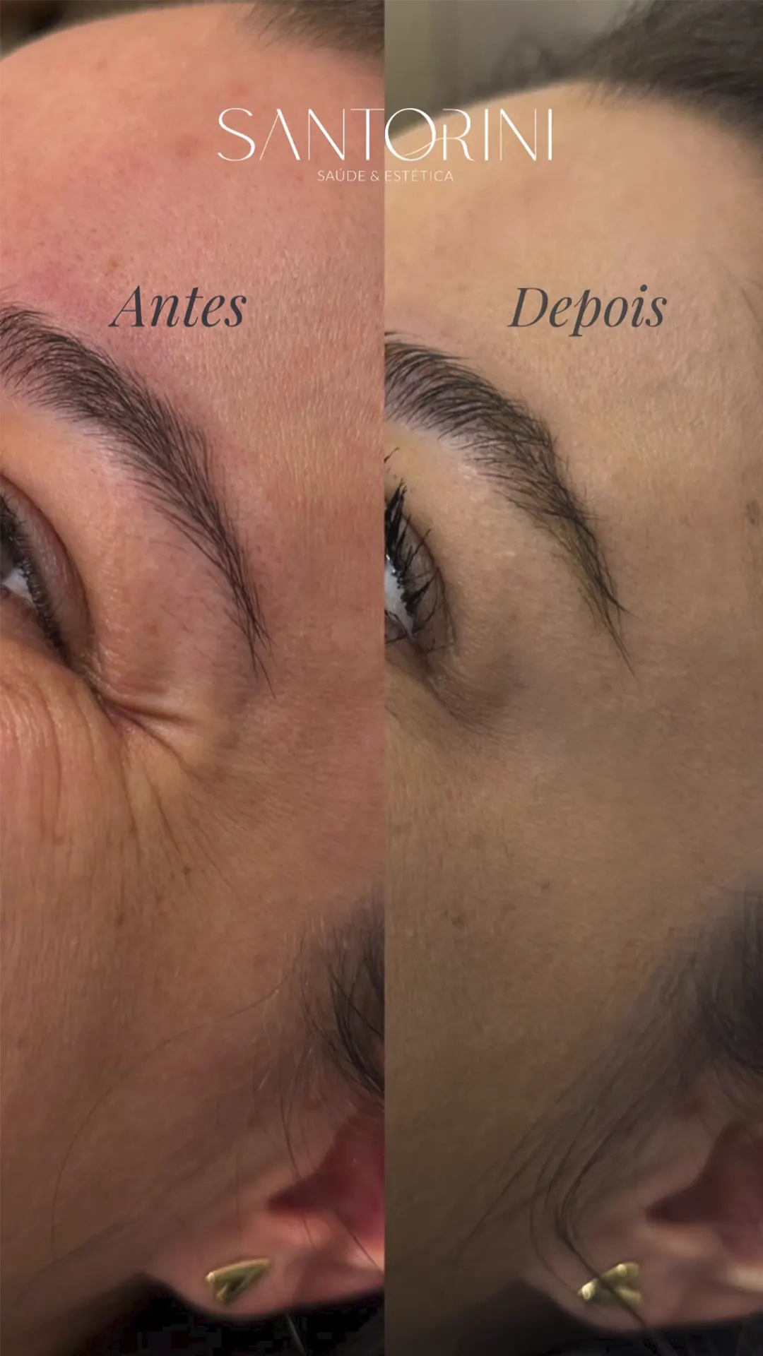 Procedimento de linhas de expressão com antes e depois 01