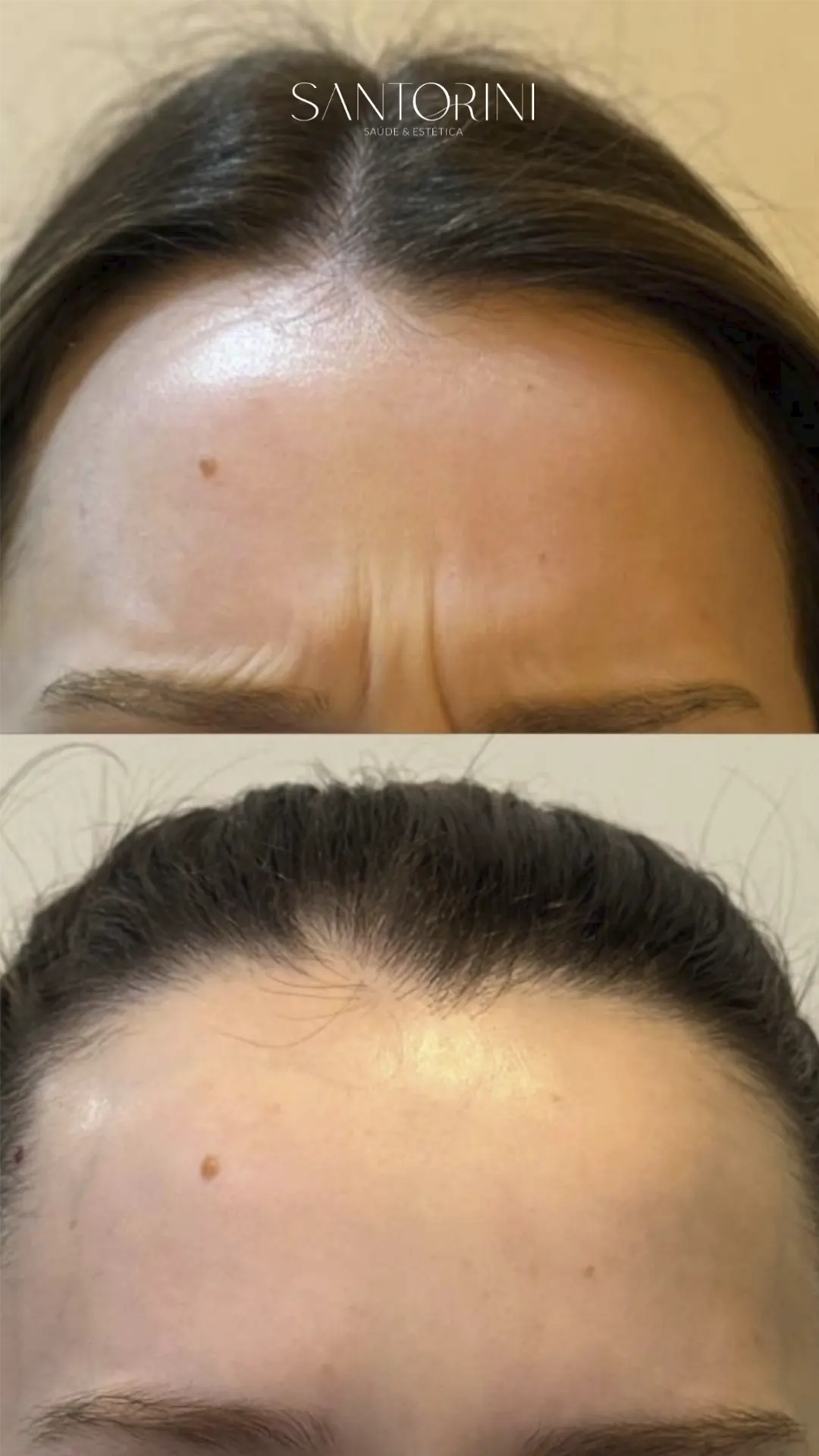 Procedimento de linhas de expressão com antes e depois 03