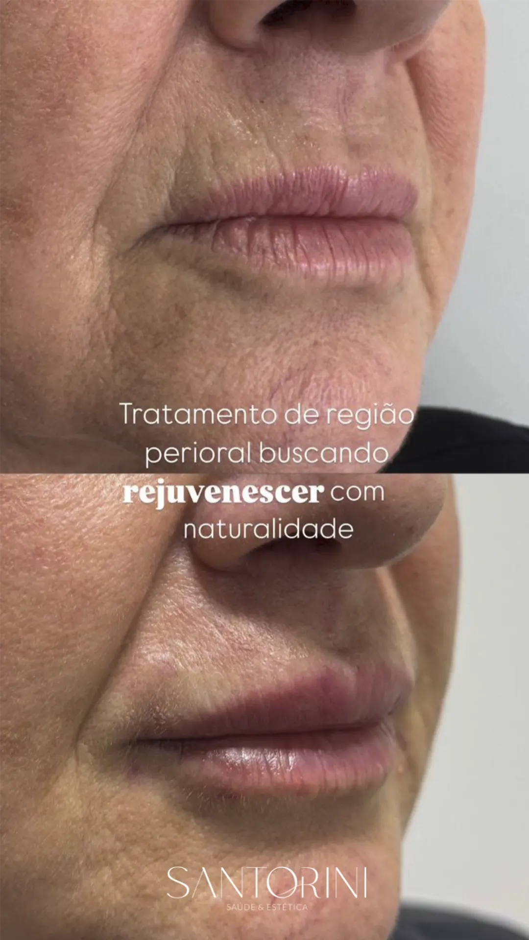 Procedimento de linhas de expressão com antes e depois 04