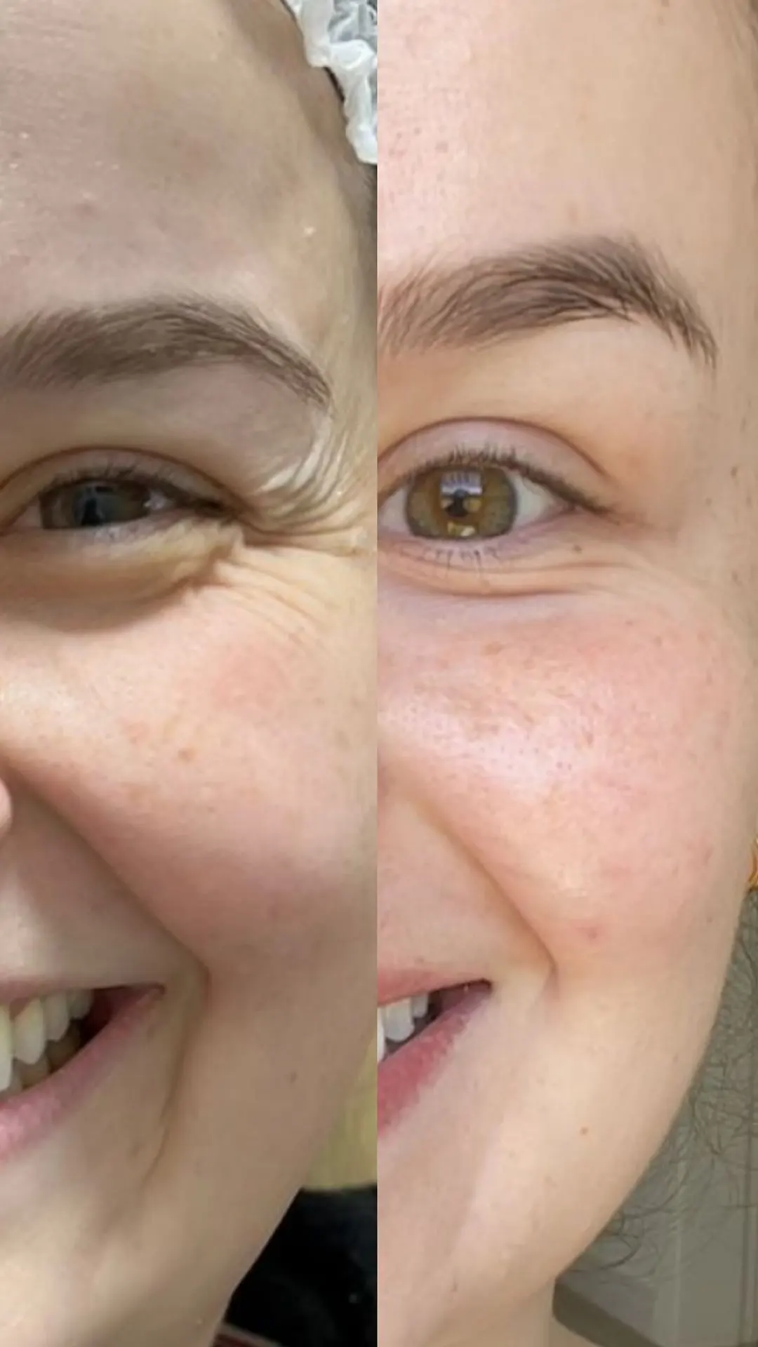 Procedimento de linhas de expressão com antes e depois 05