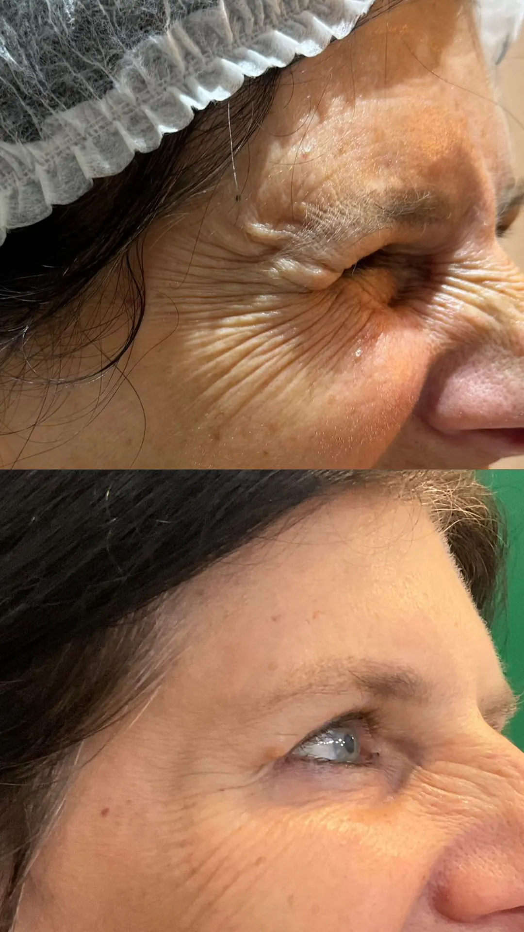 Procedimento de linhas de expressão com antes e depois 06