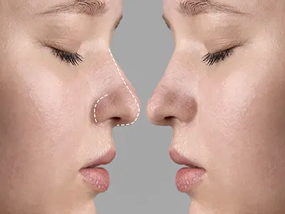 Rinomodelação com Ácido Hialurônico