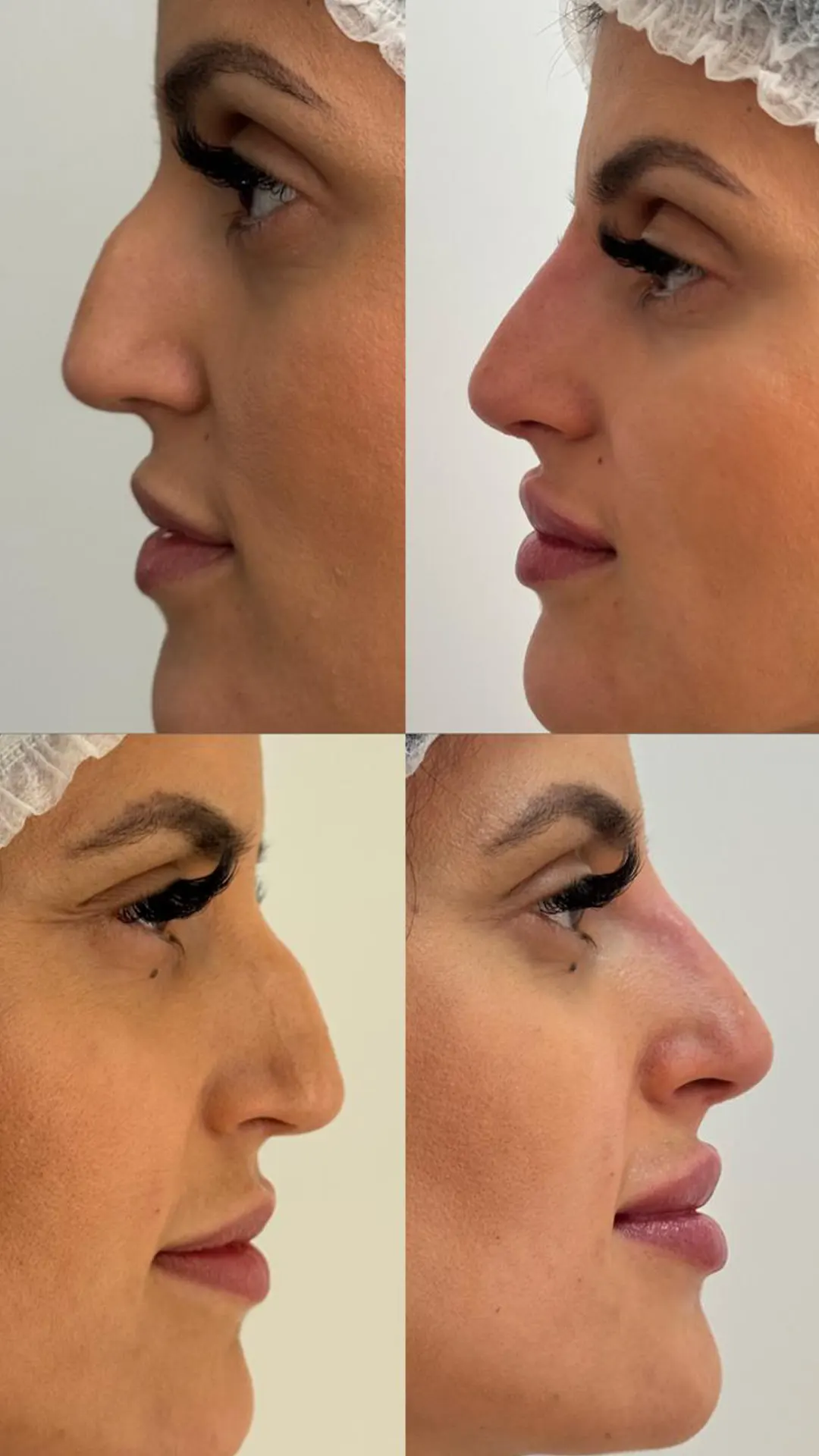 Procedimento de Rinomodelação com antes e depois 01