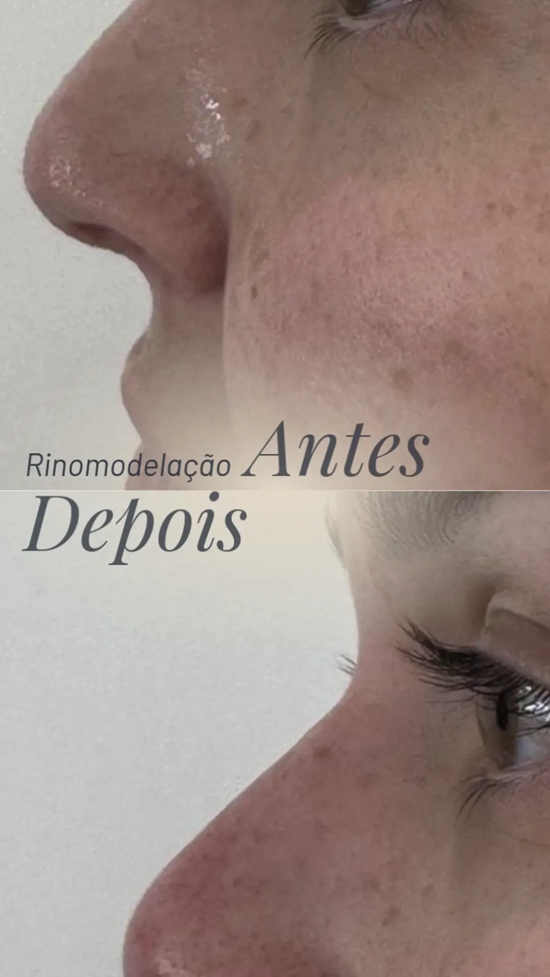 Procedimento de Rinomodelação com antes e depois 02