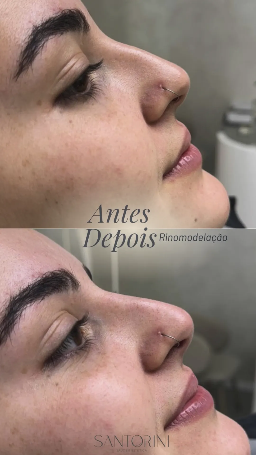 Procedimento de Rinomodelação com antes e depois 03